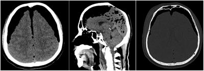 Traumatic tension pneumocephalus: a case report and perspective from Indonesia